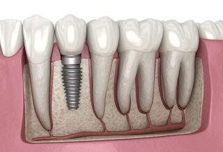 https://brisident.com/wp-content/uploads/2024/06/Dental-implant-illustration-320x218.jpg