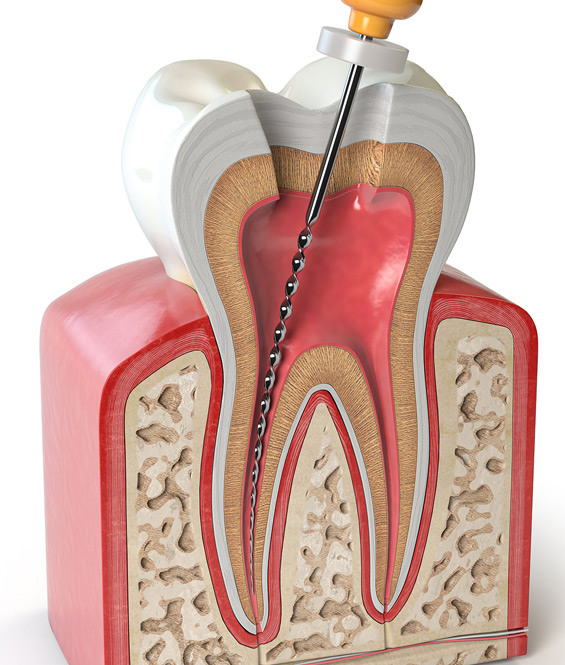 https://brisident.com/wp-content/uploads/2024/06/endodontics-2.jpg