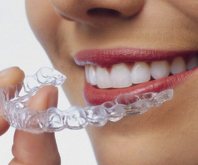 https://brisident.com/wp-content/uploads/2024/06/invisalign-1-640x533.jpg