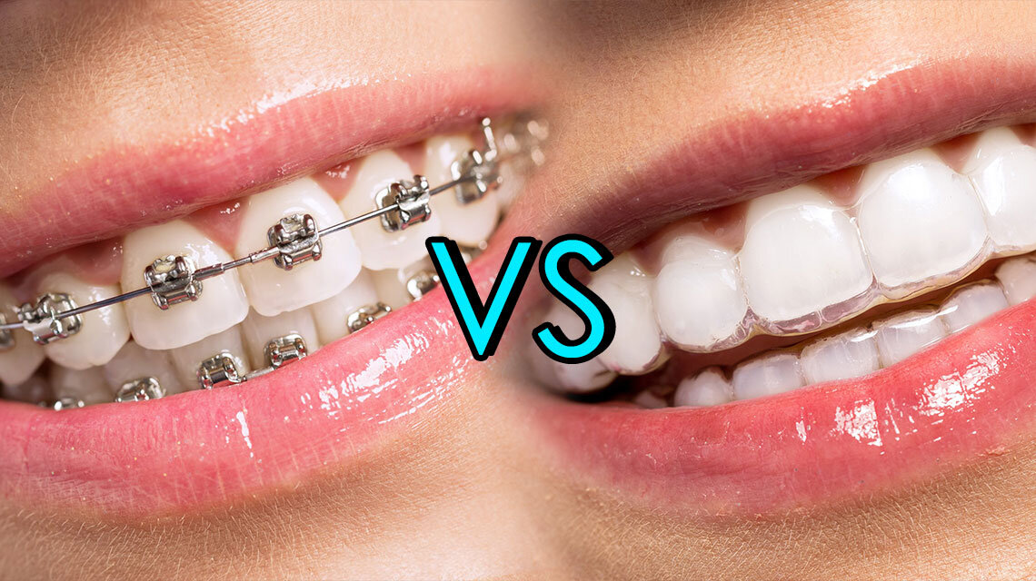 https://brisident.com/wp-content/uploads/2024/06/invisalign-vs-braces.jpg